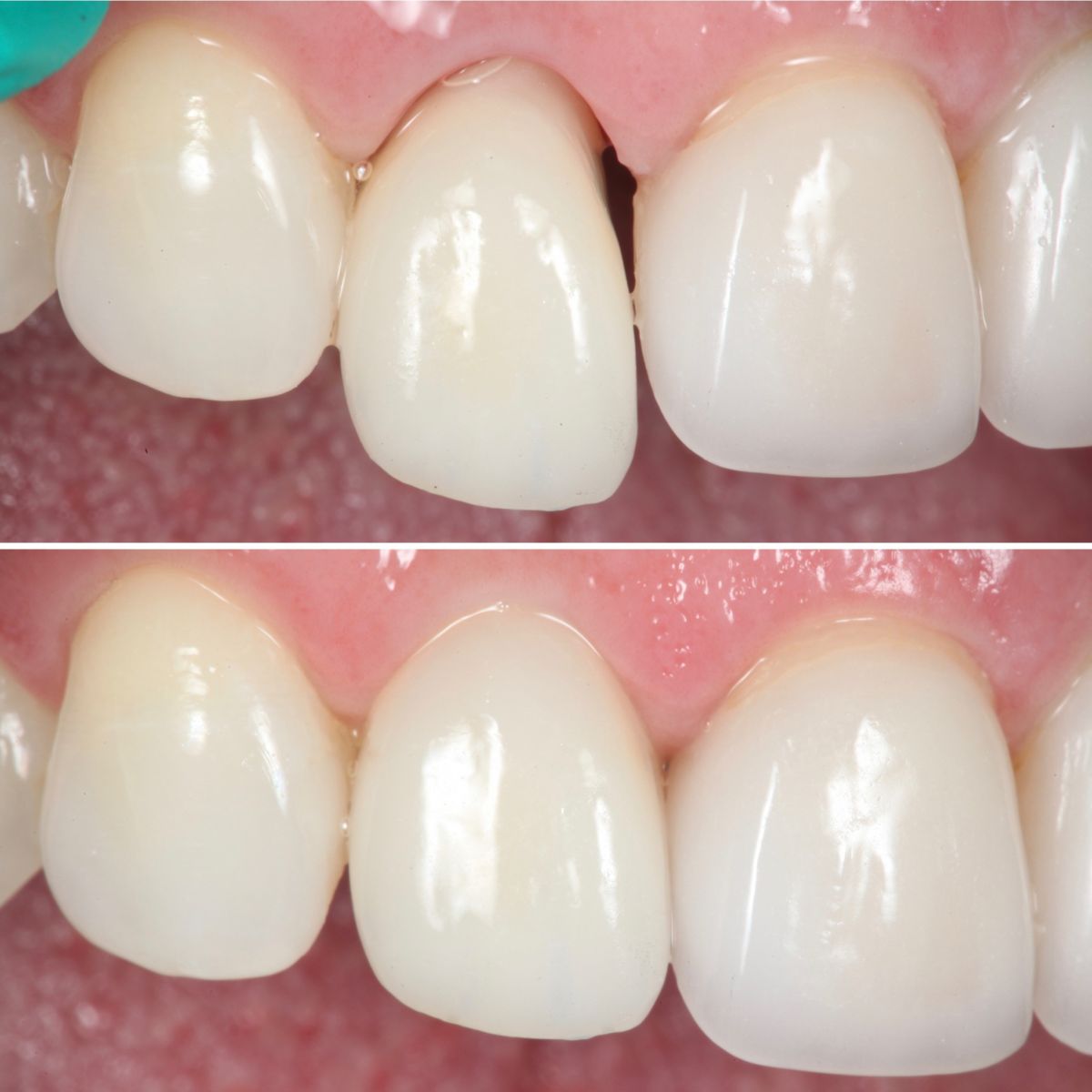 Common Procedures Strupp & Brumm Cosmetic & Restorative Dentistry